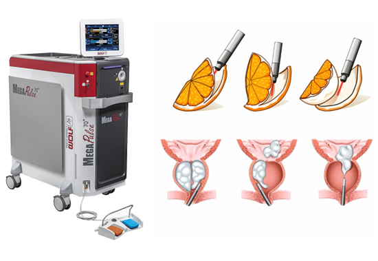 Clínica Uroderm, Cirurgia a Laser HoLEP em Montes Claros, MG Holep em Montes Claros, MG